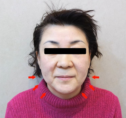 애프터사진
