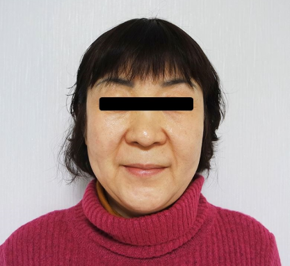 비포사진