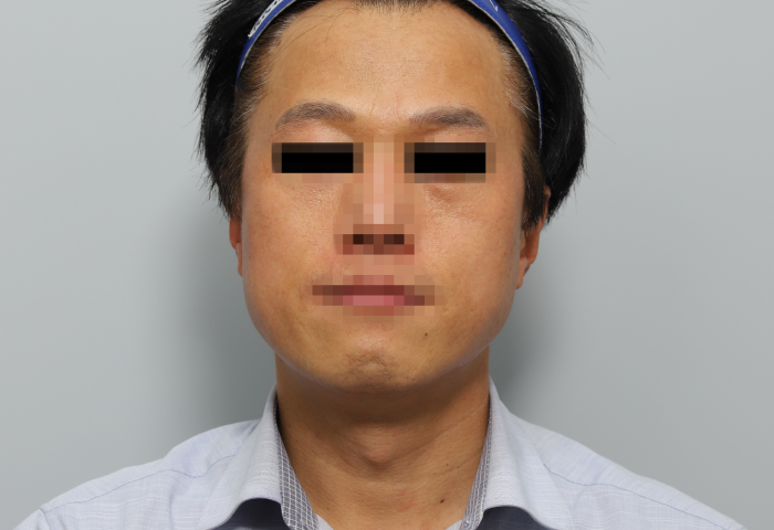 애프터사진