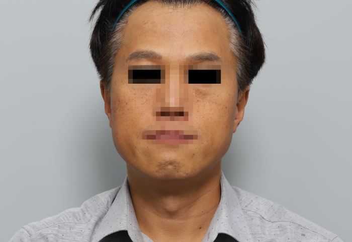 비포사진
